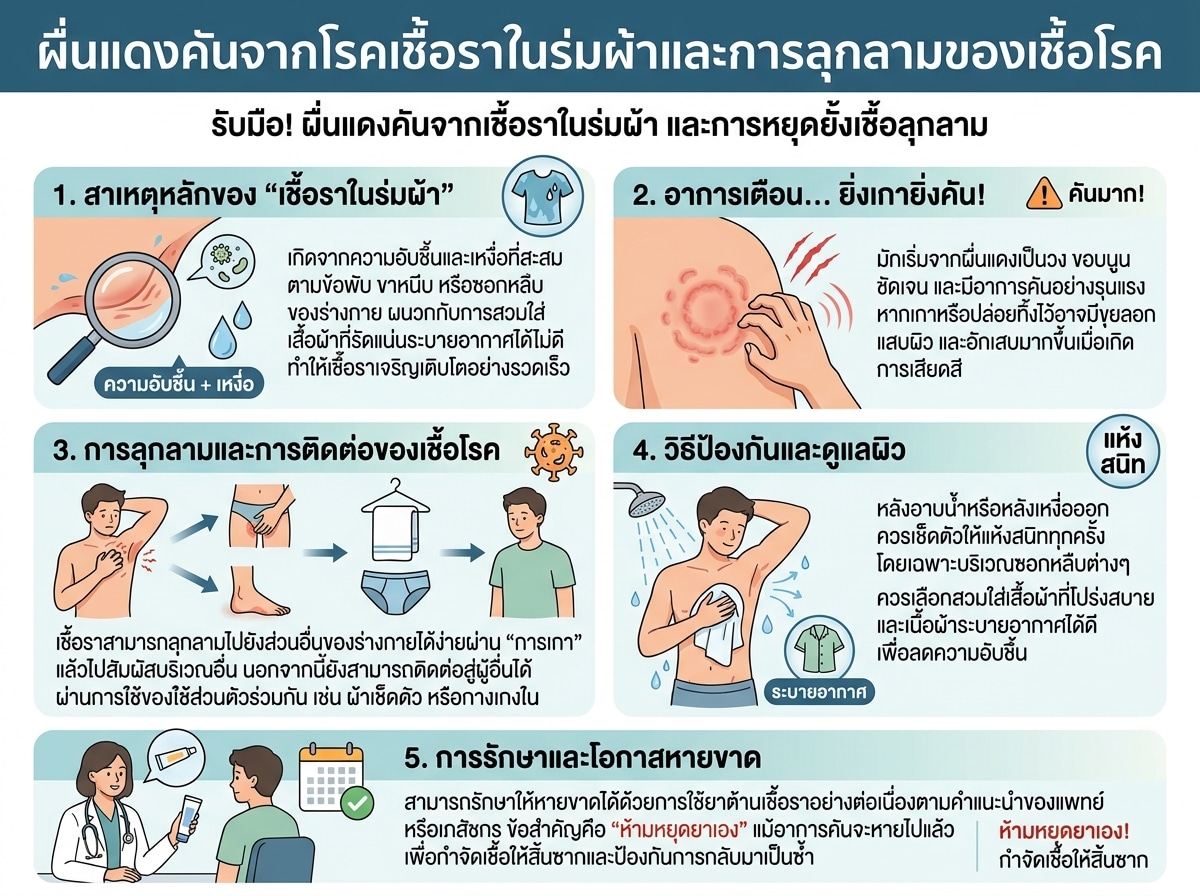 ผื่นแดงคันจากโรคเชื้อราในร่มผ้าและการลุกลามของเชื้อโรค