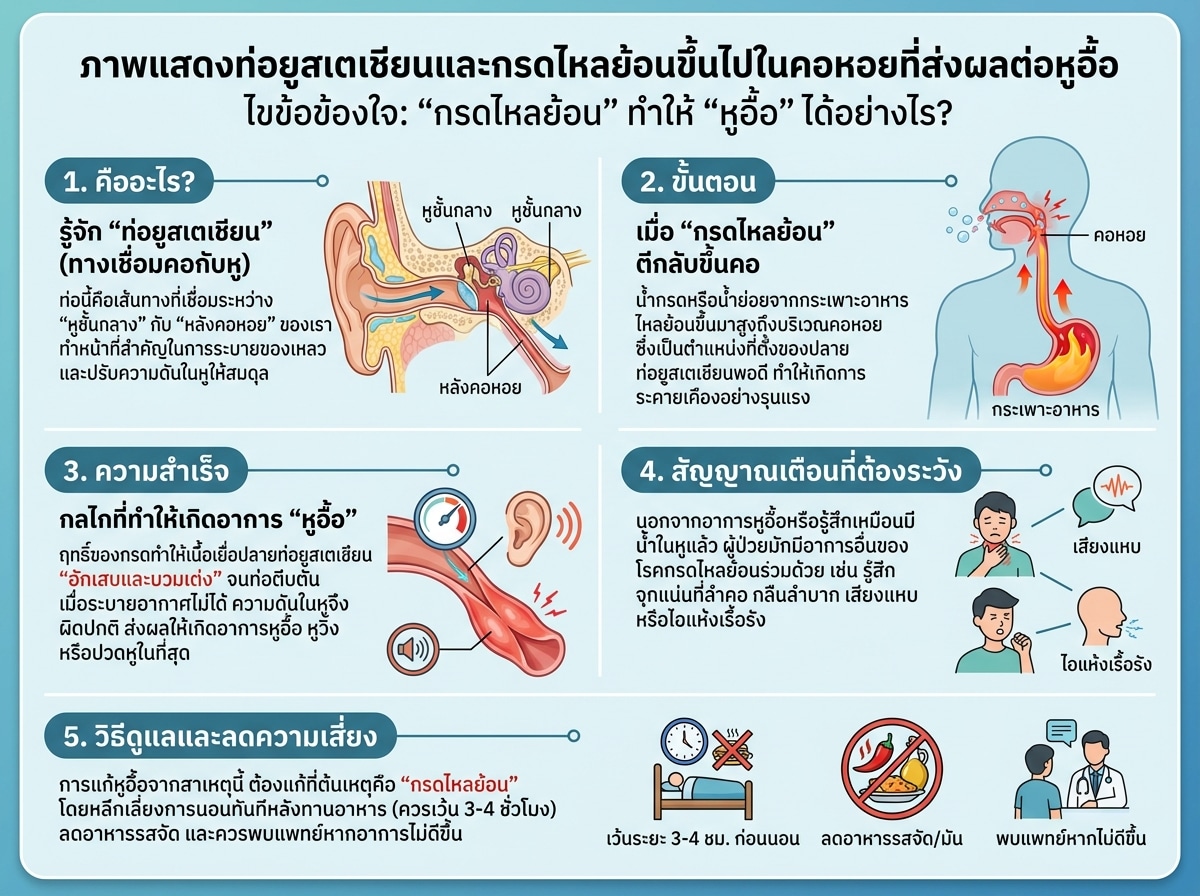 ภาพแสดงท่อยูสเตเชียนและกรดไหลย้อนขึ้นไปในคอหอยที่ส่งผลต่อหูอื้อ