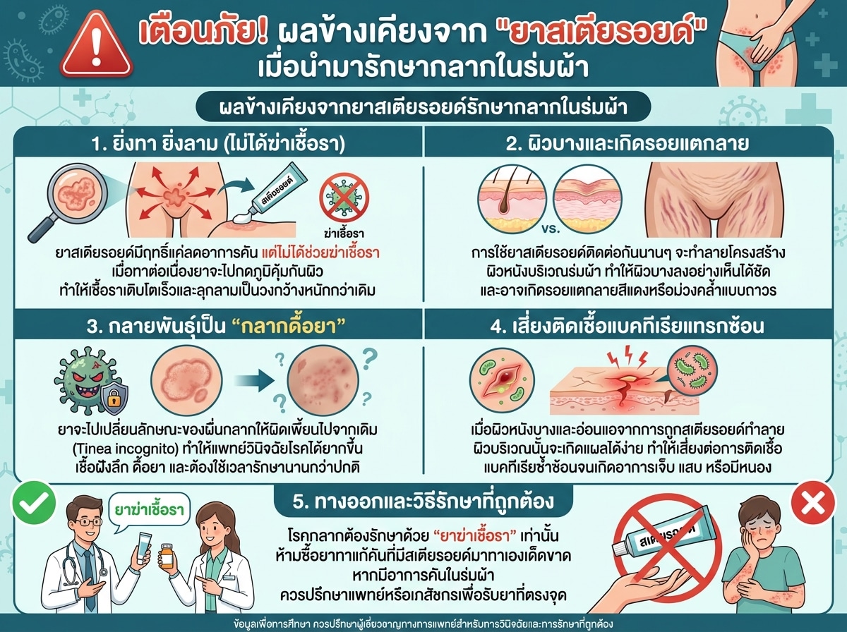 ผลข้างเคียงจากยาสเตียรอยด์รักษากลากในร่มผ้า