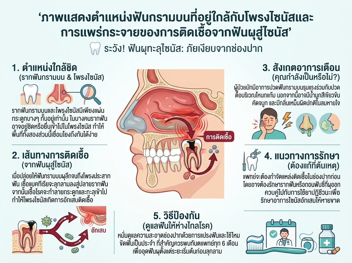 ภาพแสดงตำแหน่งฟันกรามบนที่อยู่ใกล้กับโพรงไซนัสและการแพร่กระจายของการติดเชื้อจากฟันผุสู่ไซนัส